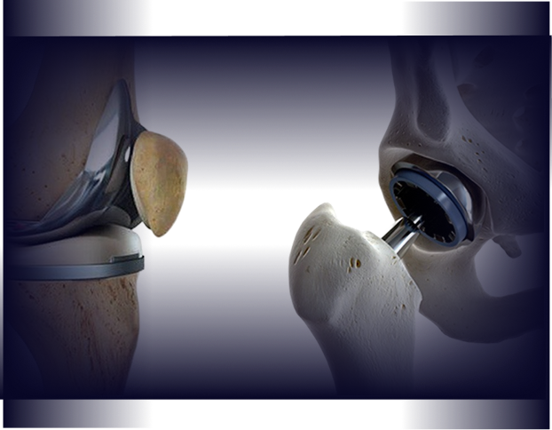 Joint Replacment image