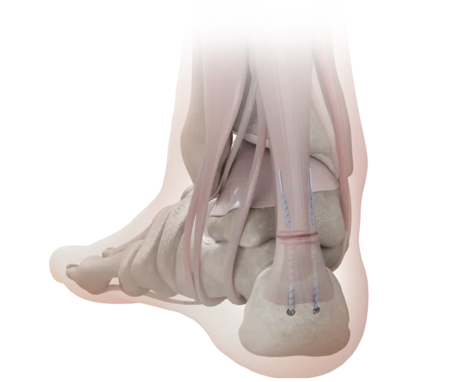 achilles_tendon_mid_portion_rupture_repair_surgery_image