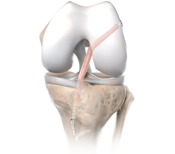 all_inside_cruciate_ligament_reconstruction_et_buttonmini_with_knotless_anchor_fixation_image