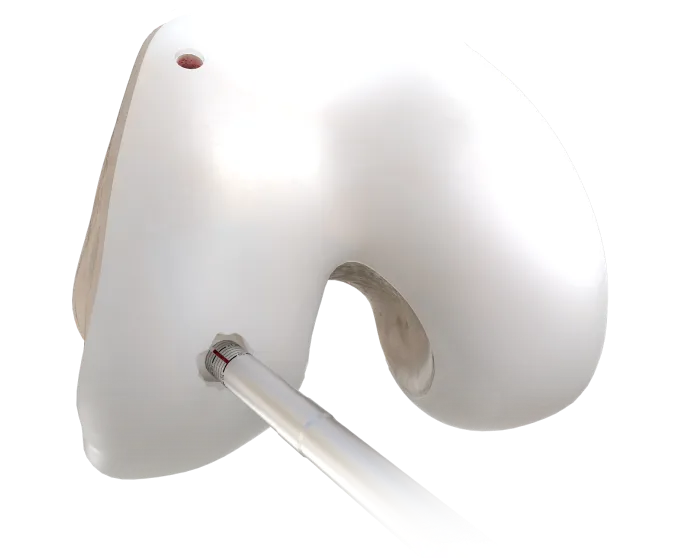 arthroscopic_autogenous_osteochondral_mosaicplasty_image
