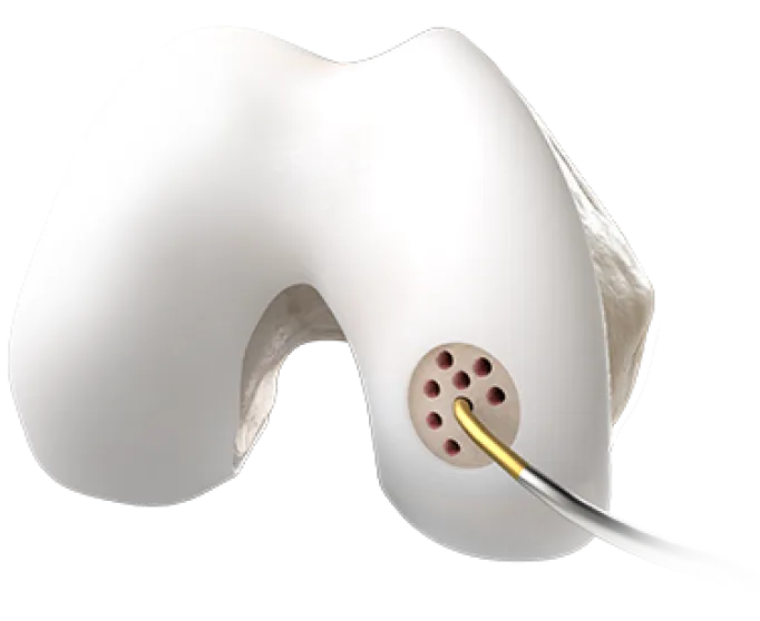 arthroscopic_microfracture_surgery_image