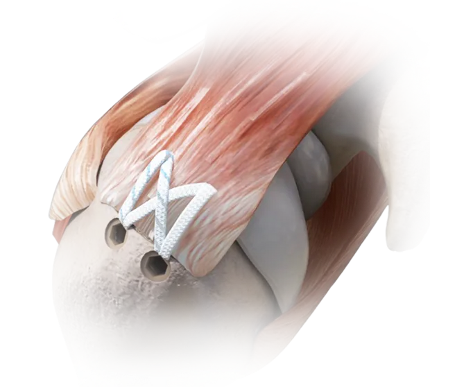 double_row_rotator_cuff_repair_using_peek_anchors_and_knotless_anchors_image