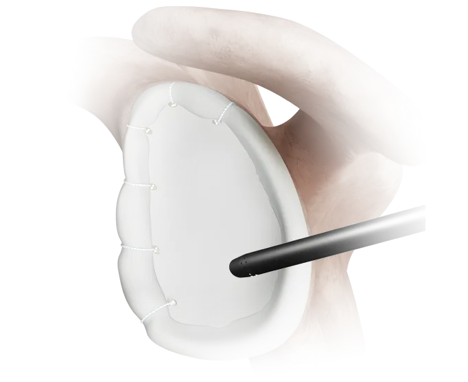 instability_realloc_knotless_suture_anchor_image
