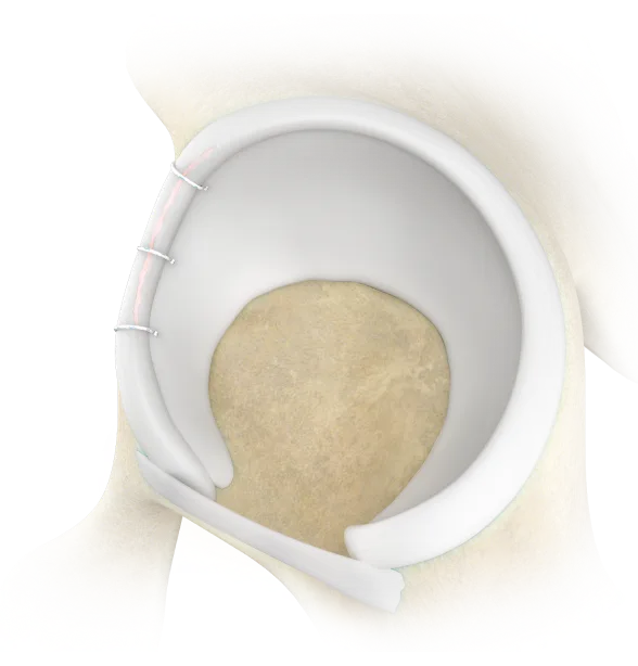 labral_repair_knotless_suture_anchor_repair_procedure_image