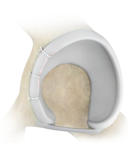 labral_repair_suture_anchor_repair_surgery_image