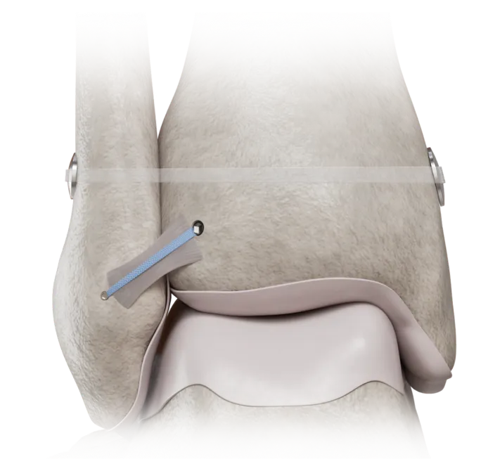lower_tibiofibular_syndesmosis_injury_titanium_plate_repair_image (1)