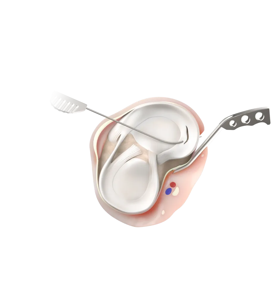 meniscal_repair_inside_out_meniscal_posterior_horn_repair_image
