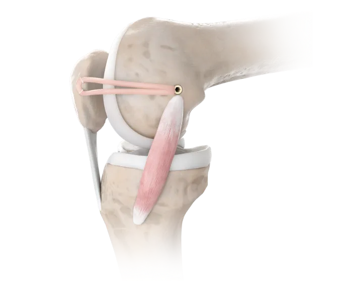 mpfl_reconstruction_image