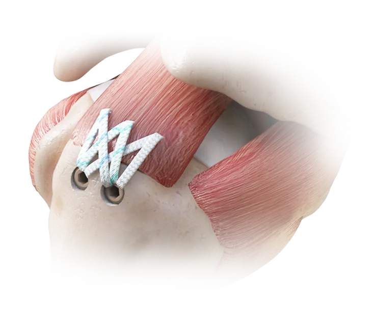 rotator_cuff_repair_hybrid_double_row_technique_all_suture_medial_row_knotless_lateral_row_fixation_image