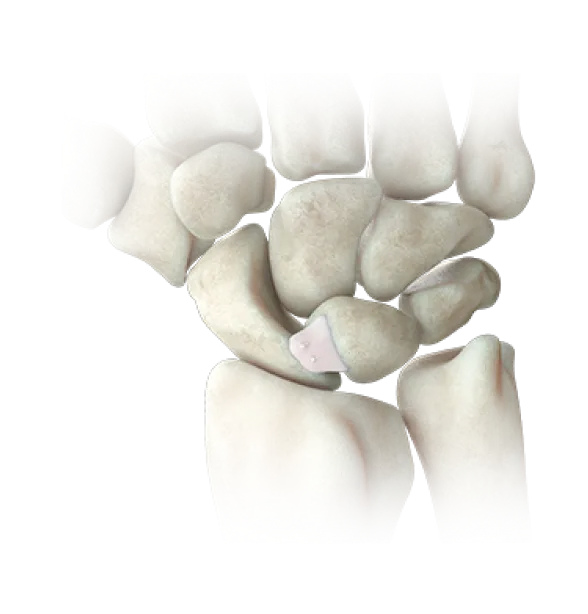 scapholunate_ligament_injury_repair_surgery_image