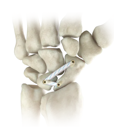 suture_ligament_augmentation_of_the_scapholunate_ligament_image