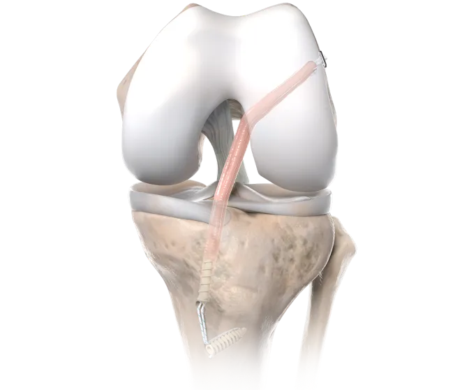 traditional_cruciate_ligament_reconstruction_with_knotless_anchor_fixation_image