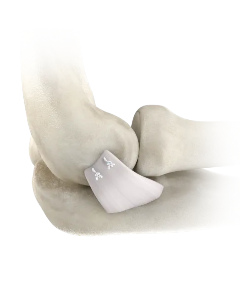 _ulnar_collateral_ligament_ucl_avulsion_injuries_image
